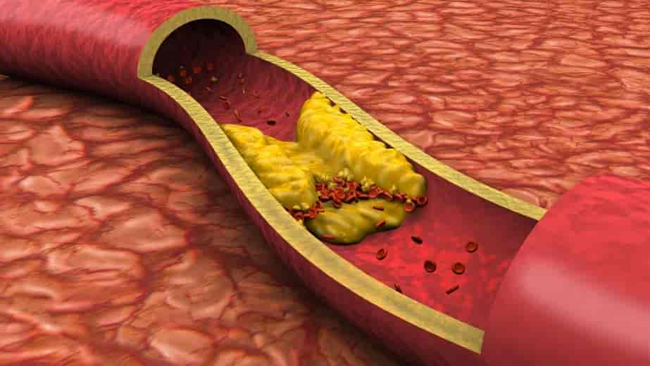 arteriosclerosis