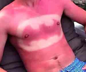 Sunburn-art