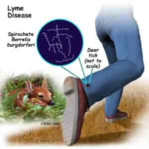 arthritis_lymedisease